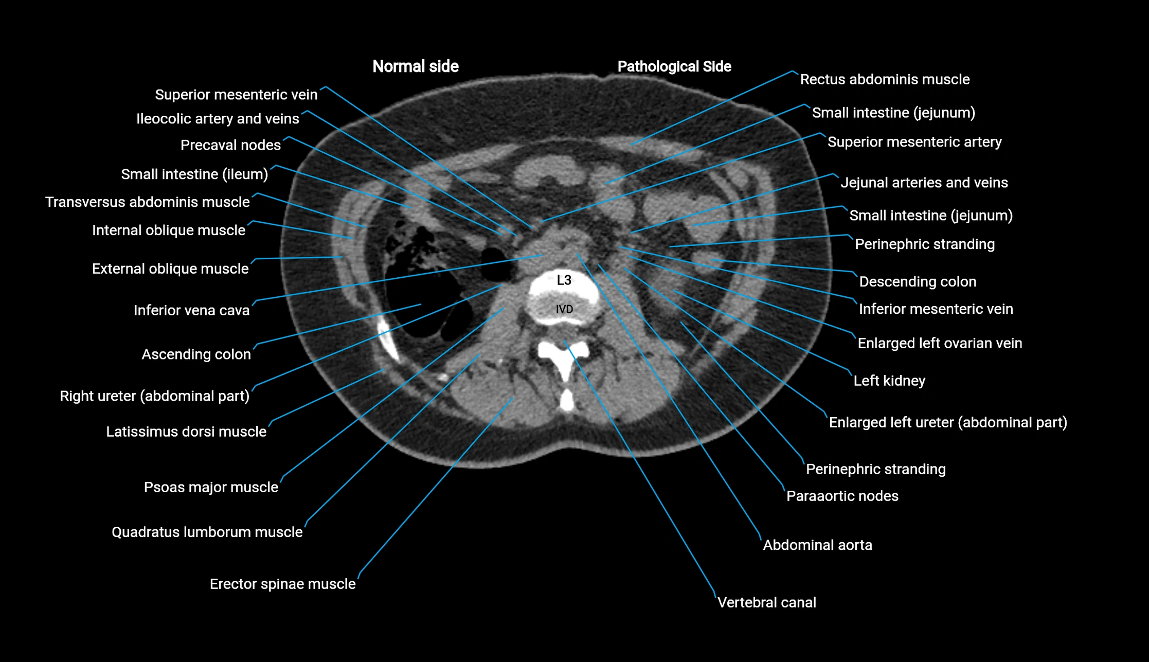 CT KUB axial cross sectional anatomy  radiology image -img-00201-00064.webp